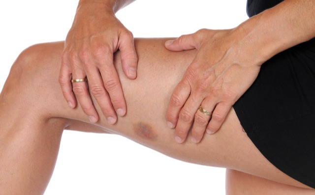 Trombózist és embóliát okoz, a nők 80%-a mégsem tud róla