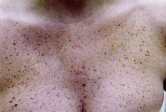 A rák 8 néma jele, amit sokan összekevernek mással