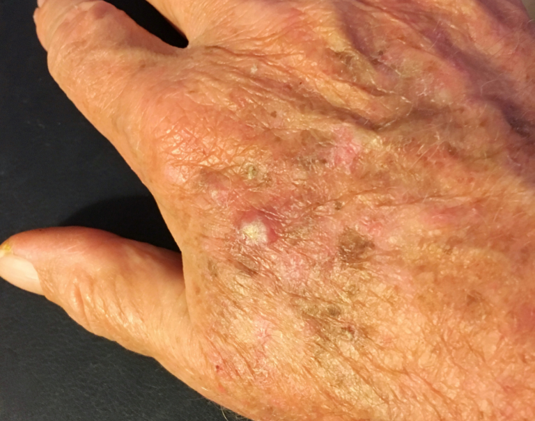 Így jelenik meg a kézfejen a rák – Hónapokkal előbb figyelmeztethet