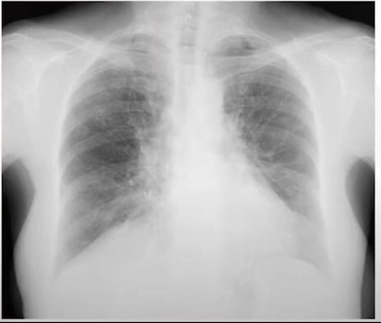 A betegség, amely hamarabb tönkreteheti a szervezetet, mint a rák! Ezek a tünetek jelentkeznek korán