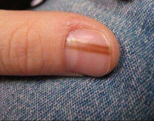 A vonalak a körmödön 40 év felett ezt jelenthetik: