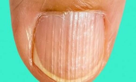 Ha neked is ilyen a körmöd, most nagyon figyelj, erről jobb ha tudsz