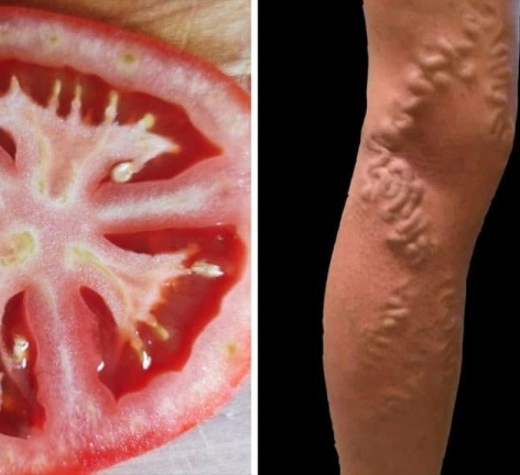 Így gyógyíthatod a visszereidet paradicsommal!