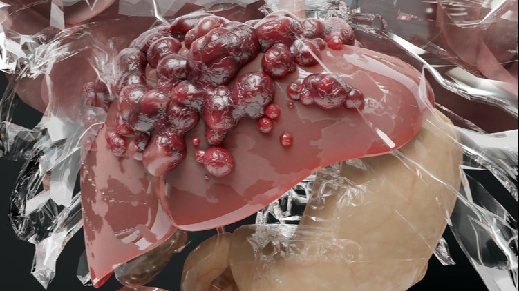 Nem fáj, nem viszket, mégis halálos lehet – egy alattomos betegség