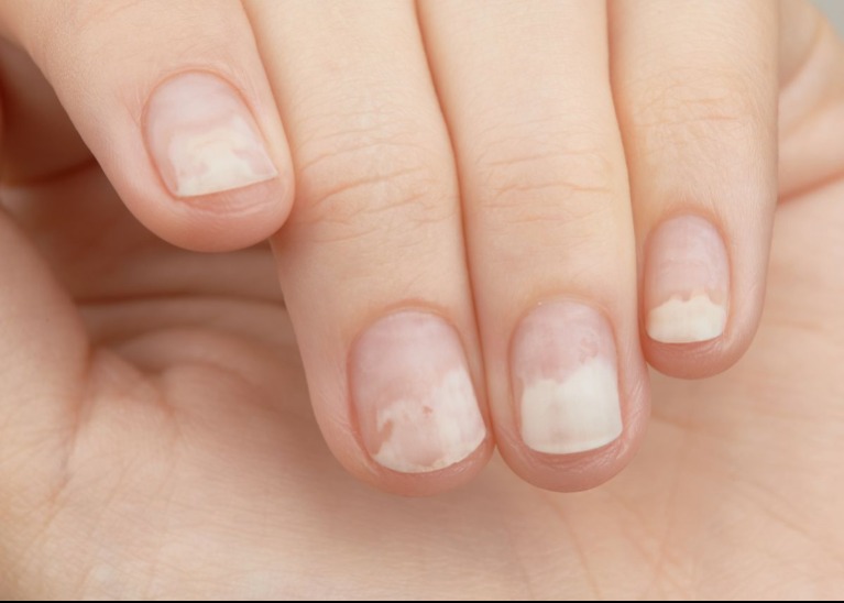 Betegségre is utalhat, ha ilyen vonalakat látsz a körmödön
