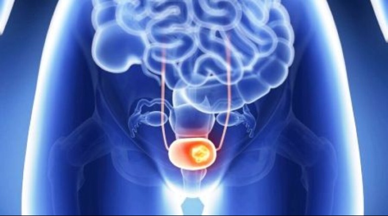 Derékfájással kezdődik, sokan nem is tudnak róla, nagyon súlyos betegség tünete